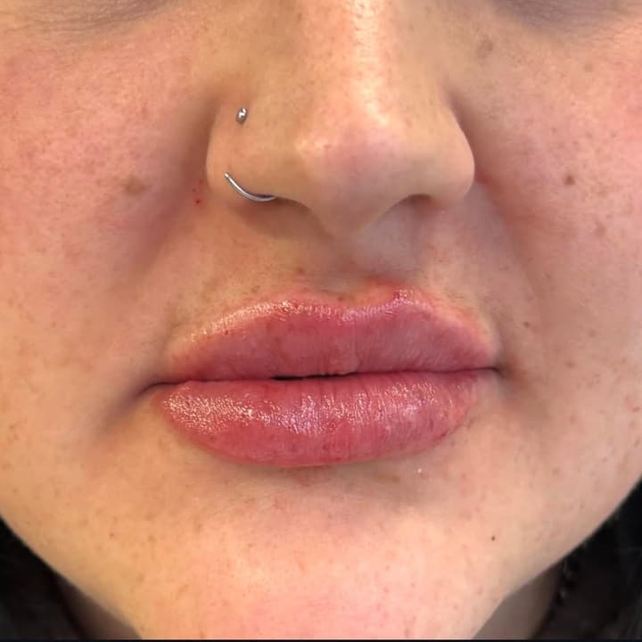 After — Asymmetry corrected with natural border definition.